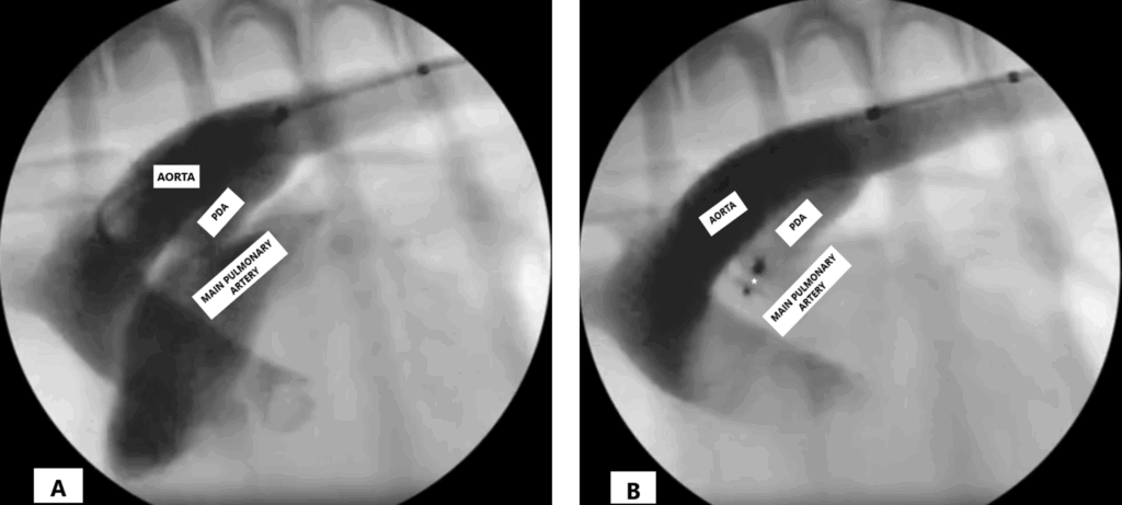 Patent Ductus Arteriosus (PDA) in Small Animals - American College of ...