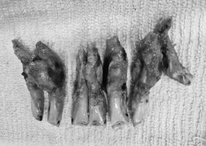 Figure 2. Extracted incisors from a horse with EOTRH.