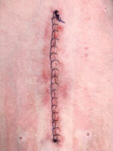 Figure 2. Picture of normal incision with skin sutures.
