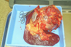 Figure 2. A spleen with a large splenic mass following complete removal of the spleen at surgery.
