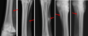 Figure 2: Radiographic images of various typical of splint bone fractures. (a) Simple fracture of the distal (lower) splint bone. (b) Comminuted splint bone fracture with multiple fragments. (c) Chronic splint bone fracture with excessive callus formation. (d) Comminuted fracture of the proximal (upper) splint bone.