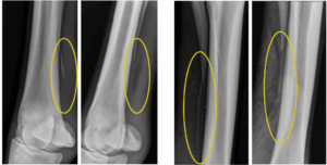 Figure 4. Radiographs before and after removal of the fracture portion of the splint bone.